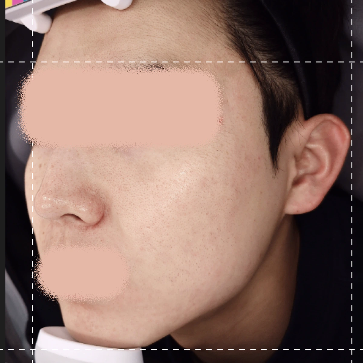 ภาพถ่ายหลังการรักษาสิว