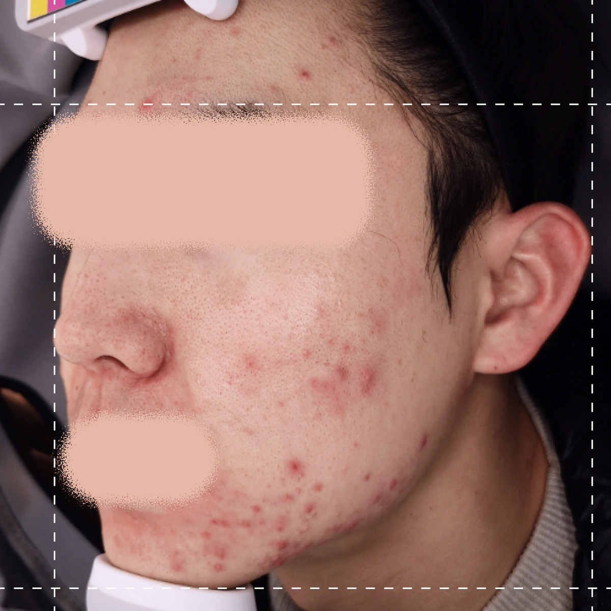 ภาพก่อนการรักษาสิว