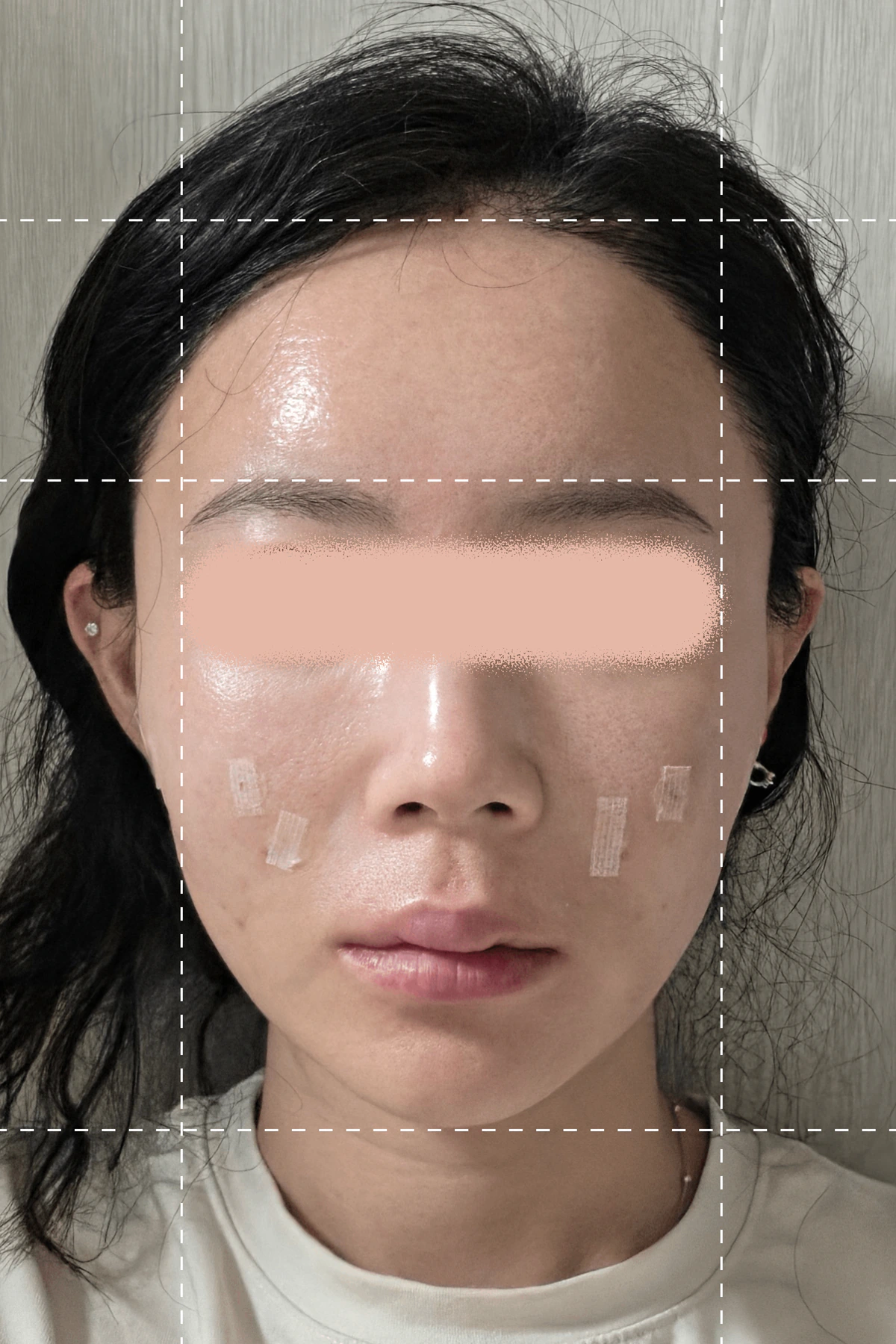 ภาพถ่ายทันทีหลังจากการทำทรีตเมนต์จัดฟันด้วยไหม