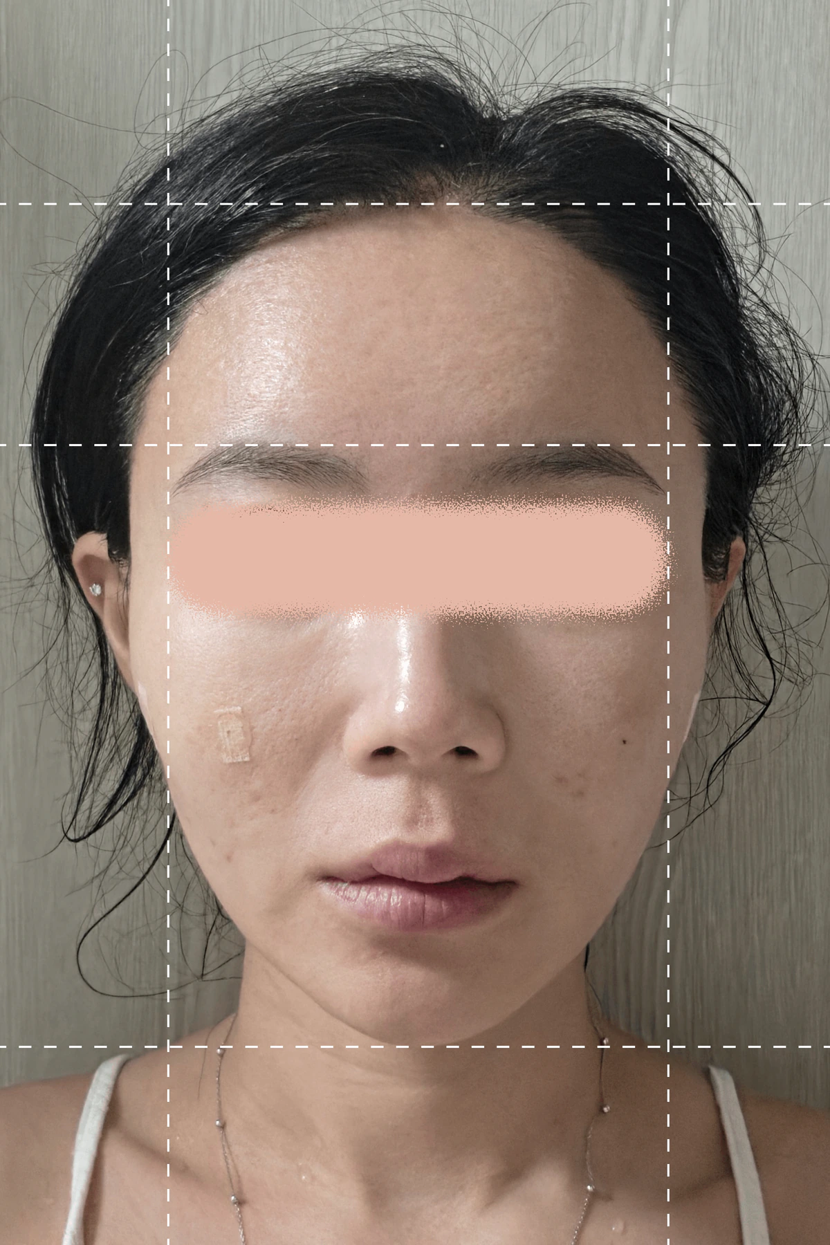ภาพถ่าย 1 สัปดาห์หลังจากการทำทรีตเมนต์ยกกระชับด้วยไหม