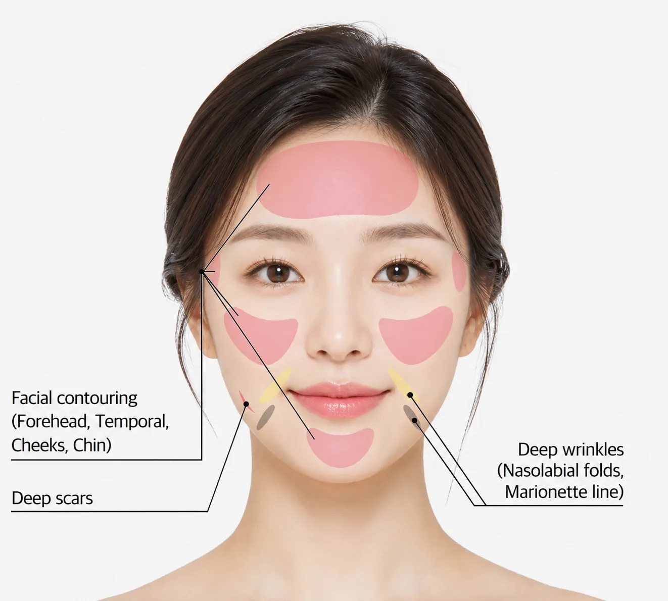 บริเวณที่ทำการรักษาด้วย Juvelook Volume