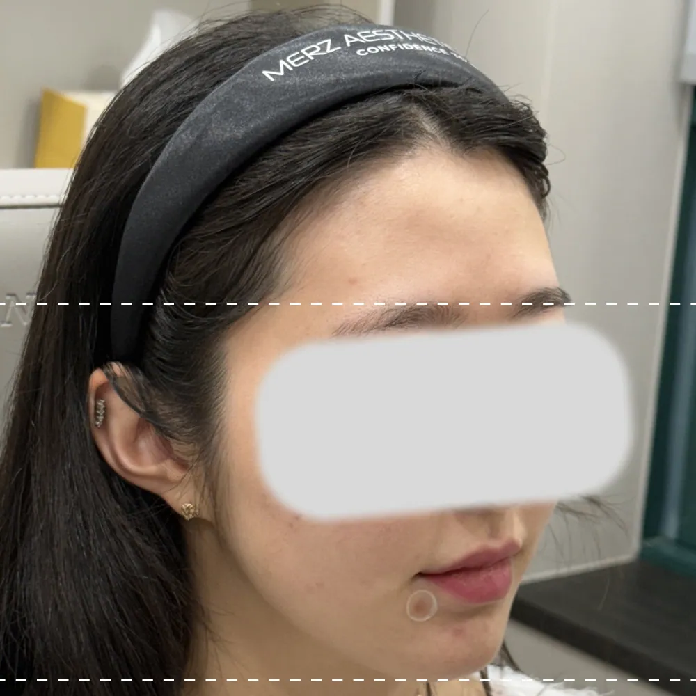 ฉีดฟิลเลอร์ที่หน้าผากด้านขวา ทำมุม 45 องศา ก่อนทำการรักษา