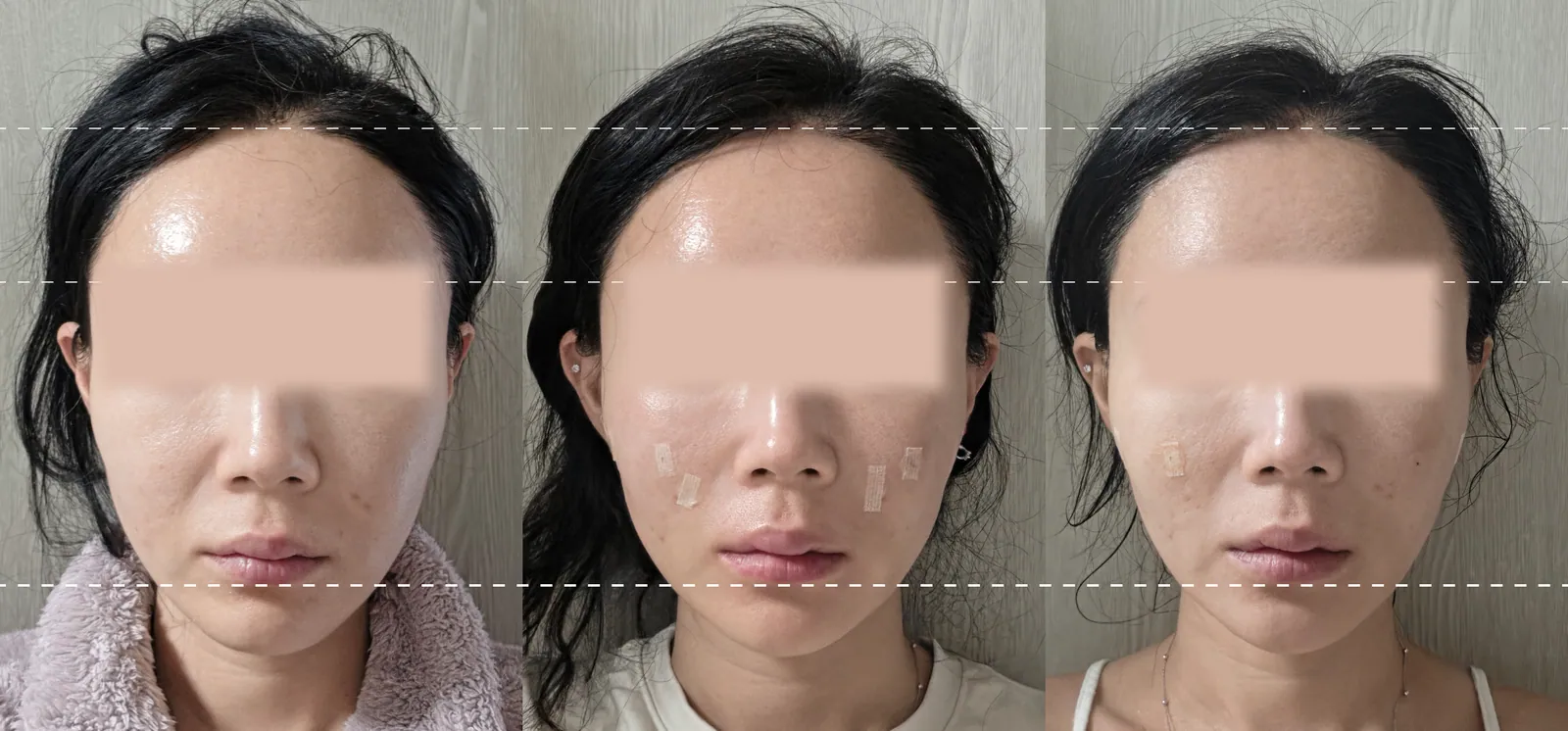 ภาพก่อนและหลังทำ Silsculpting