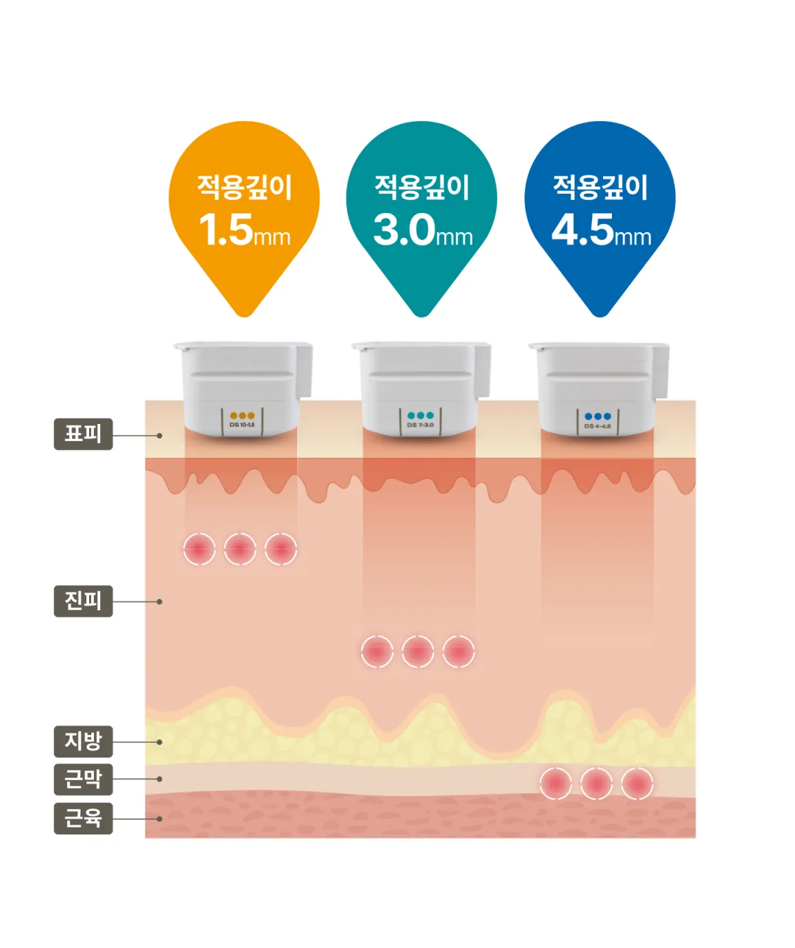 แผนภาพแสดงความลึกของการประยุกต์ใช้บริเวณดวงตา